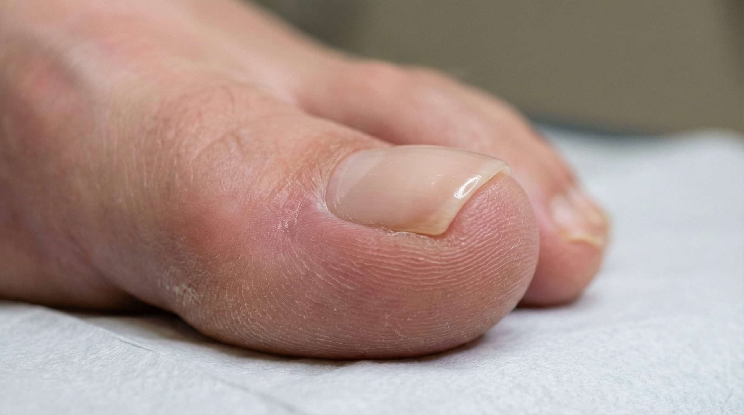 Ein gesunder Nagel nach Anwendung der Nagelspangentechnik (Ross-Fraser Methode).