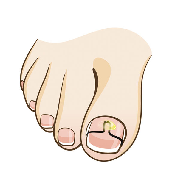 Behandlung eingewachsener Nägel mit der Nagelspangen